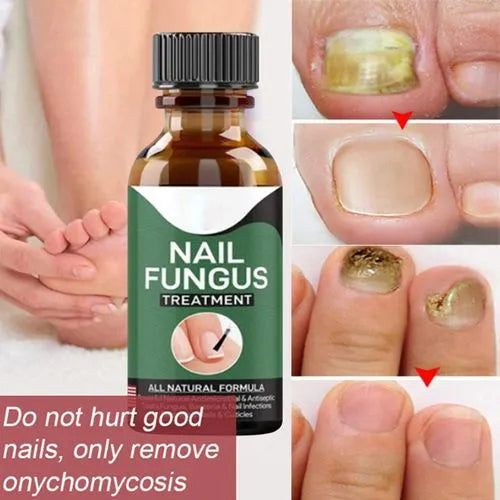 Nail Fungus Removal Gel (Imported)