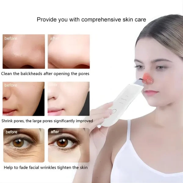 Blackhead Shovel Machine For Facial Skin Scrubber Lifting Moisturizing & Cleansing Skin Dirt Machine - With Premium Quality